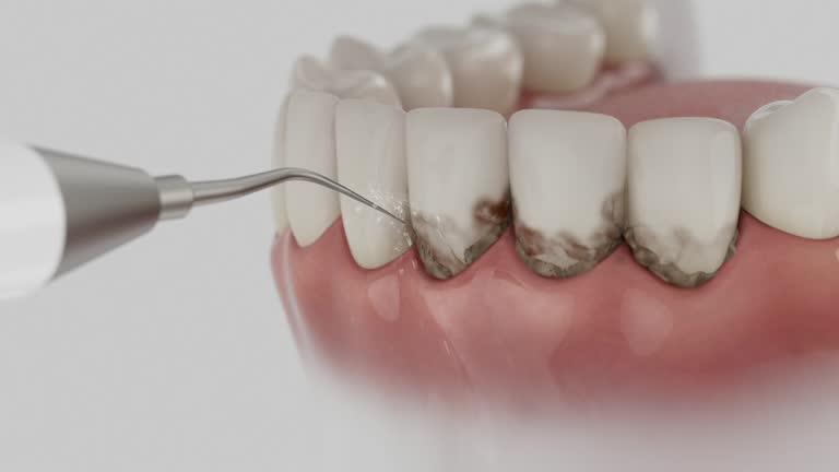Trusted Wisdom Tooth Removal service in Hansville, WA - Dentist Open Now